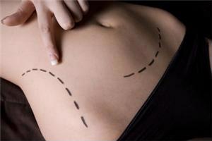 Reflections for laser liposuction. 
