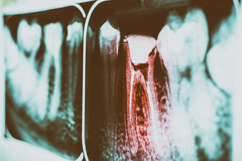 Root canals have been linked to many chronic diseases, such as cancer.